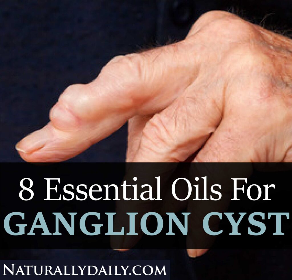 8-Best-Essential-Oils-for-Ganglion-Cyst-Natural-Treatment(title-image)