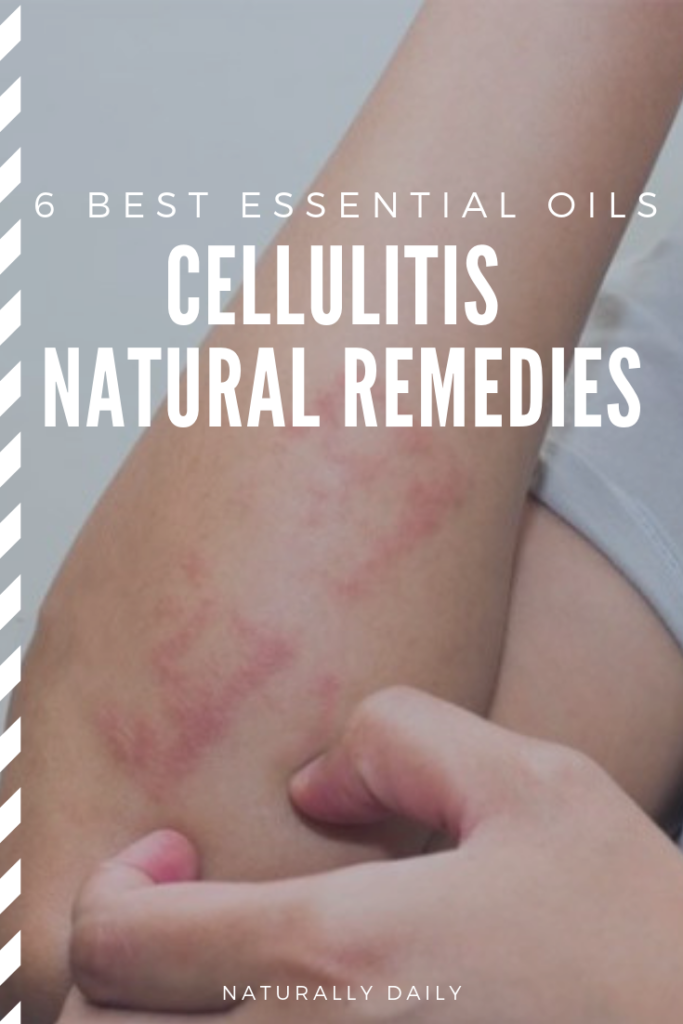 Essential-Oils-for-Cellulitis