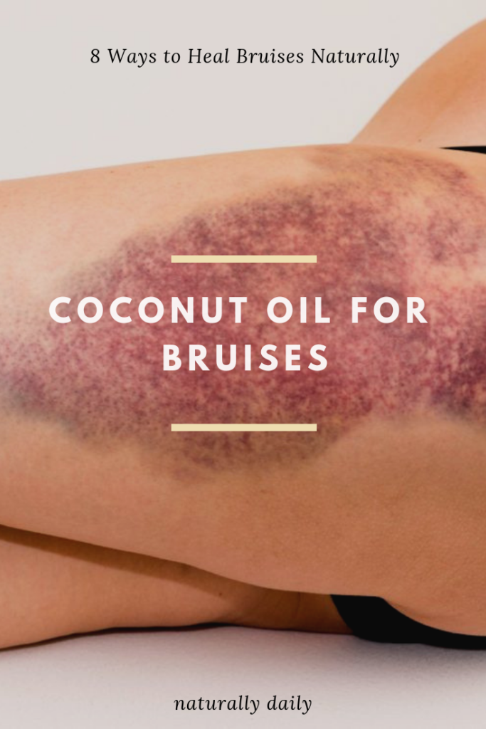 COCONUT-OIL-FOR-BRUISES(title-image)