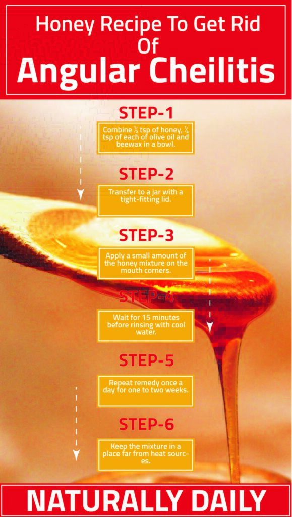 honey recipe to get rid of angular cheilitis