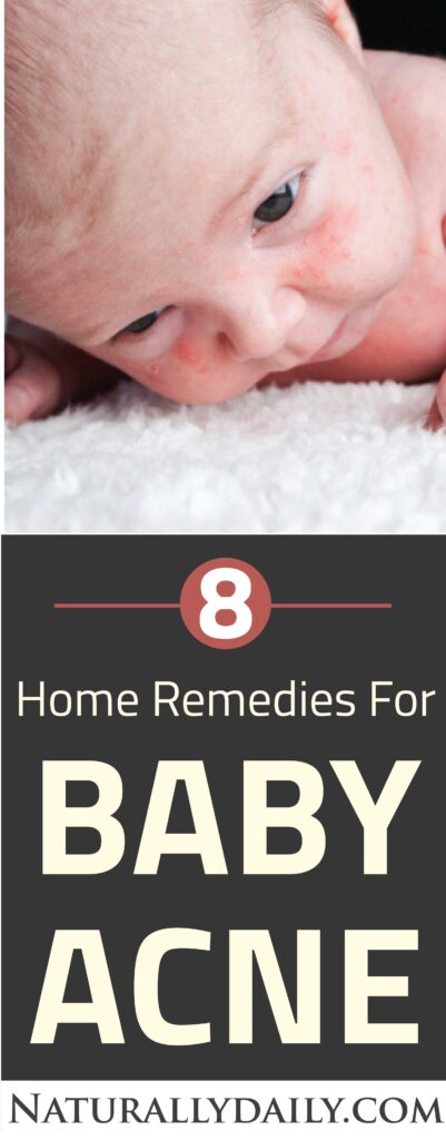 8-Safe-Home-Remedies-for-Baby-Acne(title-image