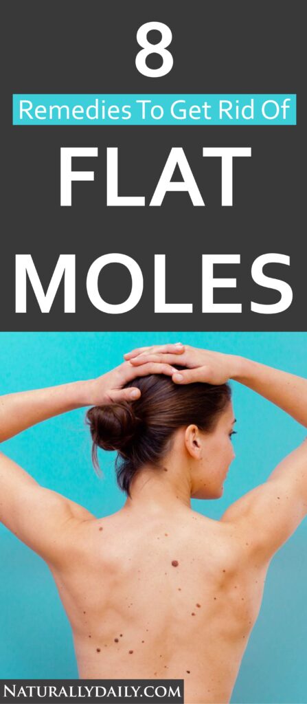 Home-Remedies-to-Remove-Flat-Moles(title-image)
