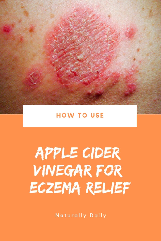 6-Ways-to-Use-ACV-for-Eczema-Cure(title-image)