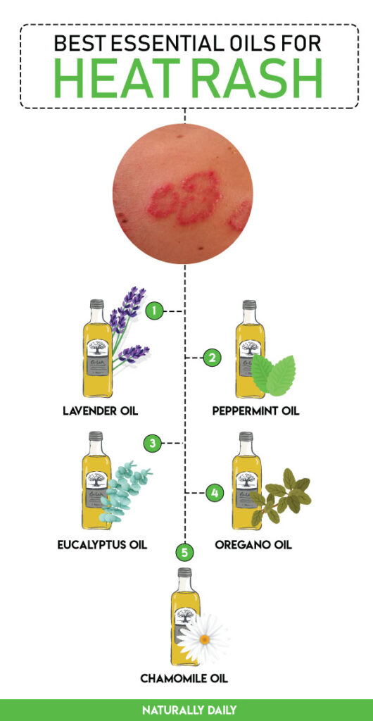 essential-oils-for-heat-rash(infographic)