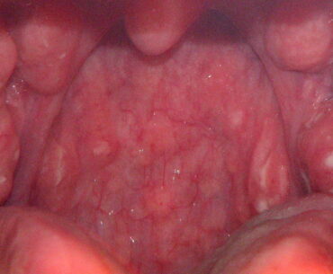 Home Remedies for Strep Throat