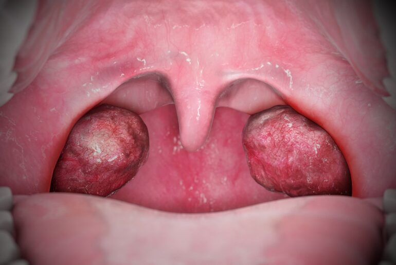 Home Remedies for Tonsillitis