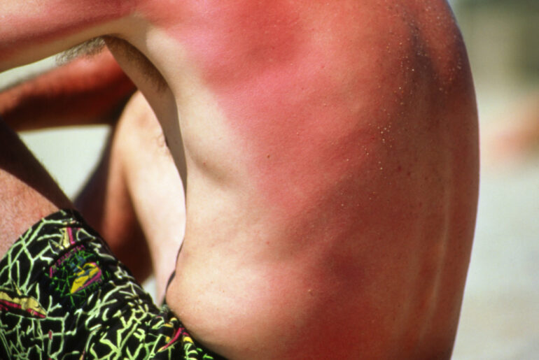 How to Get Rid of Sunburn