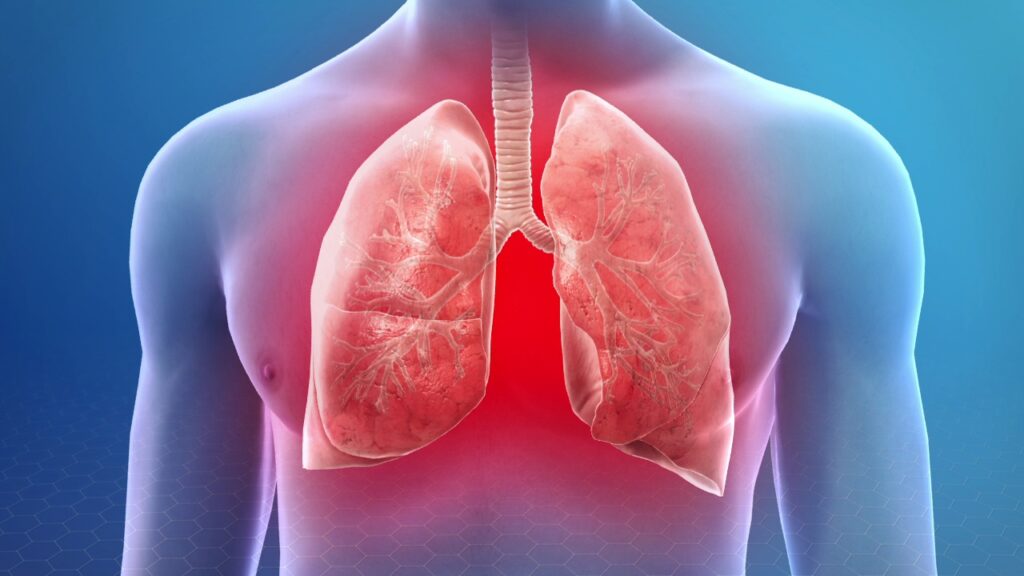 11 Natural Remedies for Pneumonia Plus How to Use Them - Naturally Daily