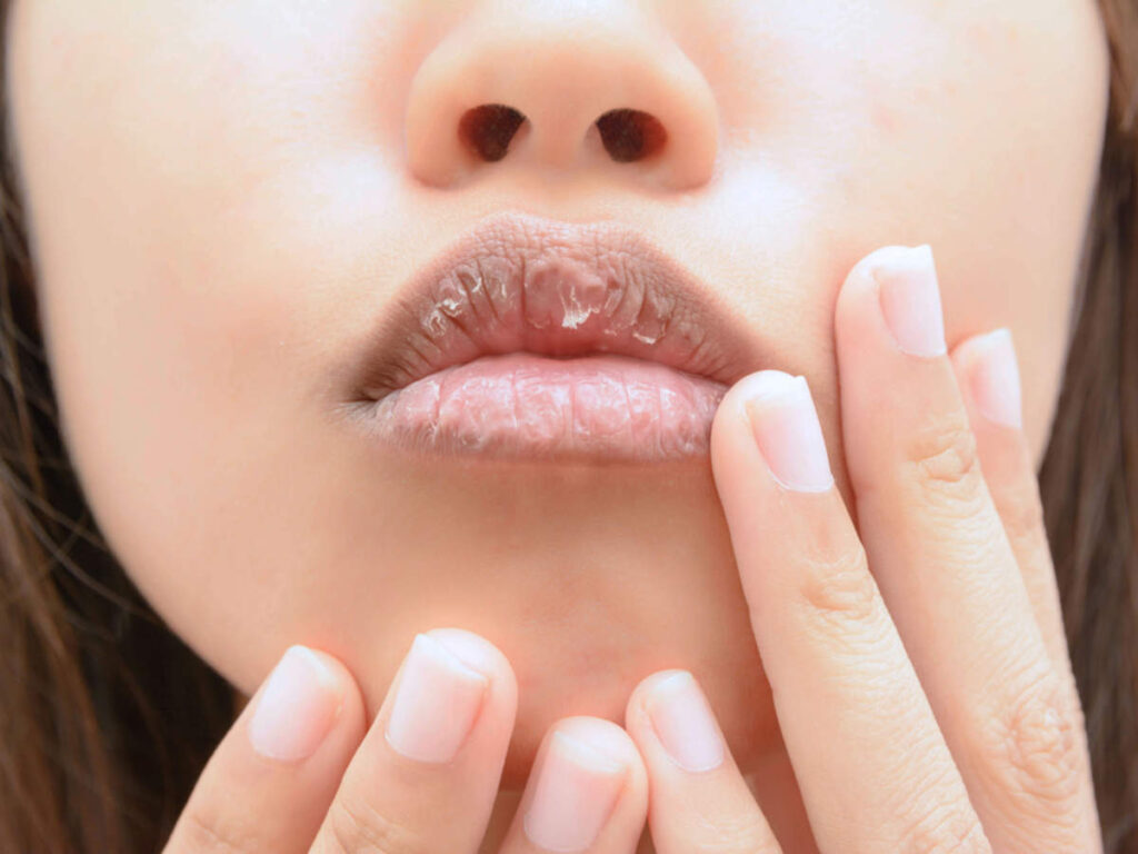 Best Ways to Get Rid Of Dead Skin on Lips Naturally Naturally Daily