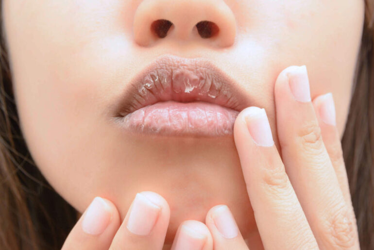 Best Ways To Get Rid Of Dead Skin On Lips Naturally Naturally Daily