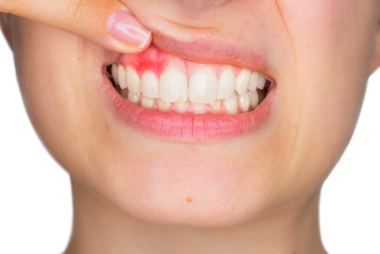 Get Rid of Gingivitis