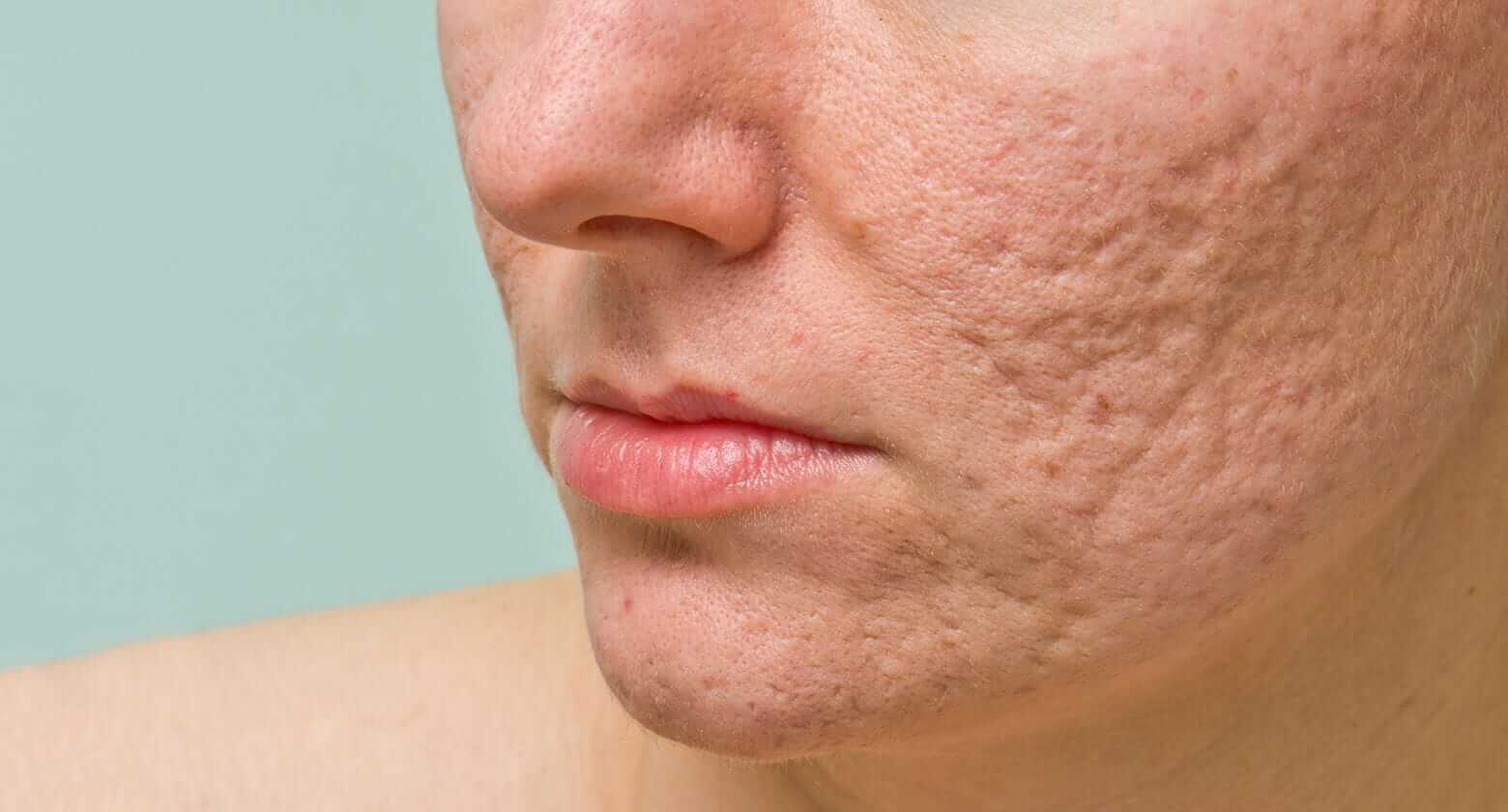 Alaw Rashes Aloe Vera For Heat Rash: 5 Reasons to Try Now! - Naturally Daily