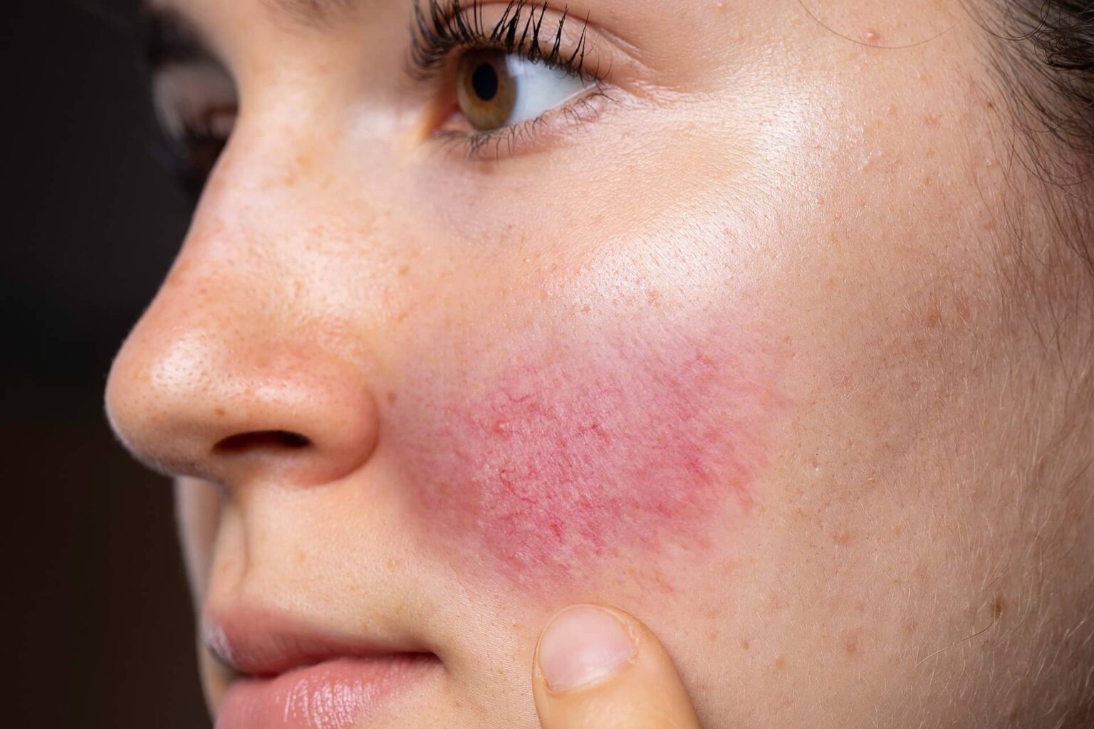 13 Essential Oils for Rosacea and How to Use Them Naturally Daily