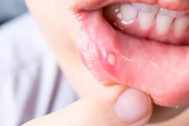 Home Remedies for Mouth Ulcer