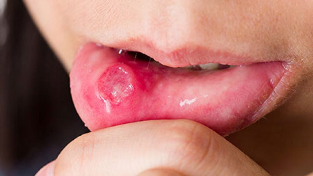 how-to-use-alum-for-canker-sores-3-best-home-remedies-naturally-daily