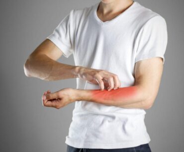 12-Home-Remedies-to-Get-Rid-of-Scabies-Naturally