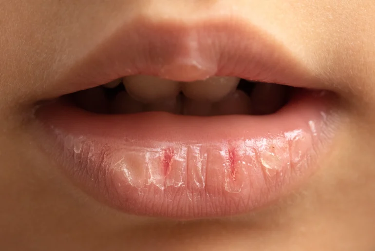 Essential Oils for Chapped Lips