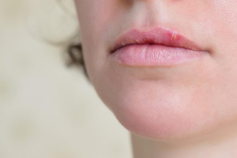 White Bumps on Lips