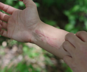 Remedies for Poison Ivy and Oak Rashes