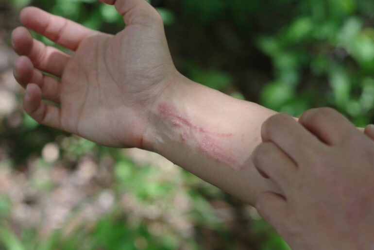 Remedies for Poison Ivy and Oak Rashes
