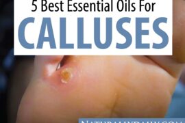 5-Essential-Oils-for-Calluses-and-Corns