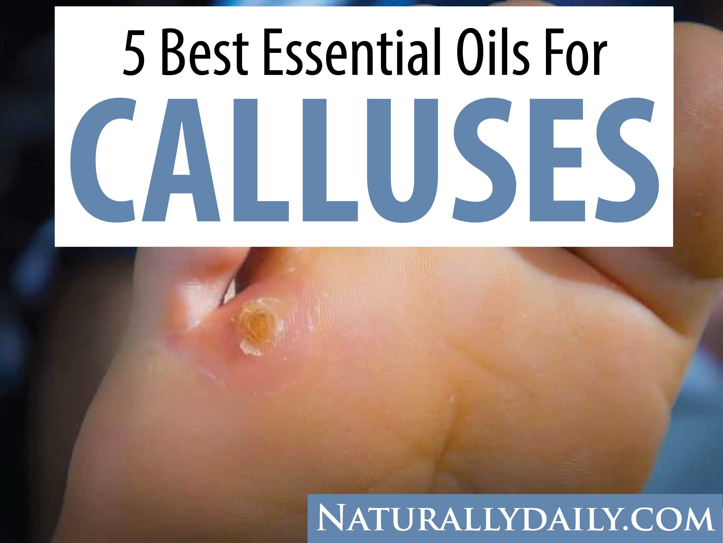 Top 11 Essential Oils For Skin Discoloration Hyperpigmentation Melasma