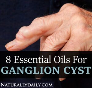 8 Essential Oils for Ganglion Cyst and How to Use Them