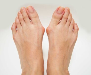 Get Rid of Bunions
