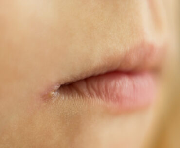 Home Remedies for Angular Cheilitis