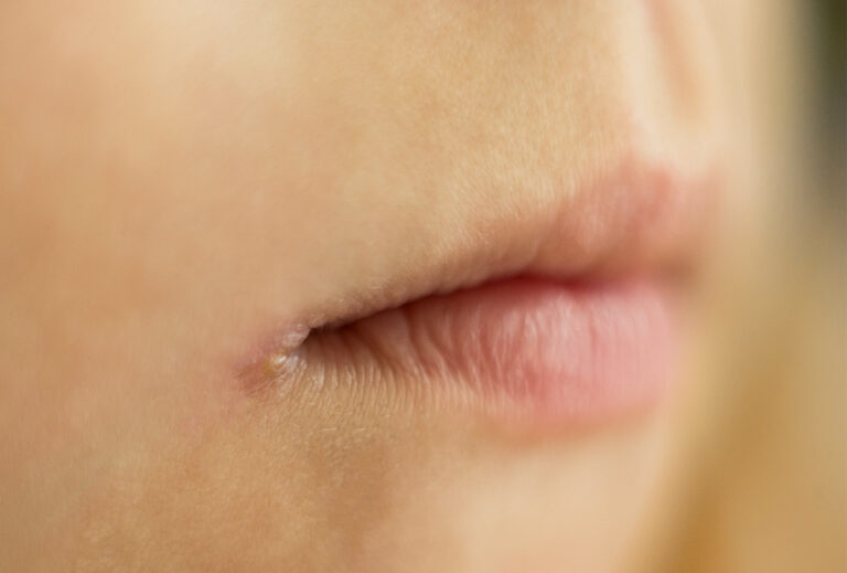 18 Quick Home Remedies For Angular Cheilitis - Naturally Daily