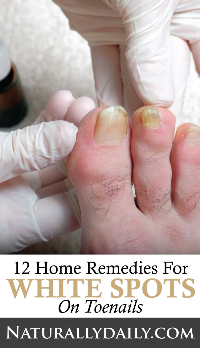 12 Home Remedies For White Spots On Toenails 6848