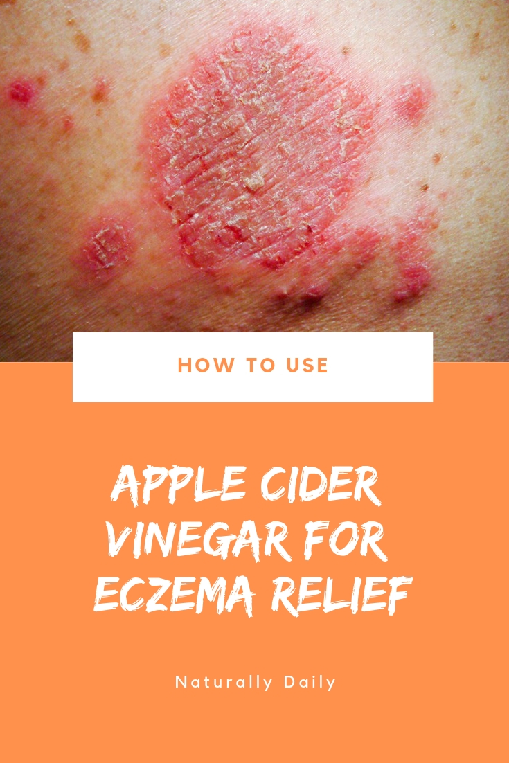 How to Use Apple Cider Vinegar for Eczema or Dermatitis Relief