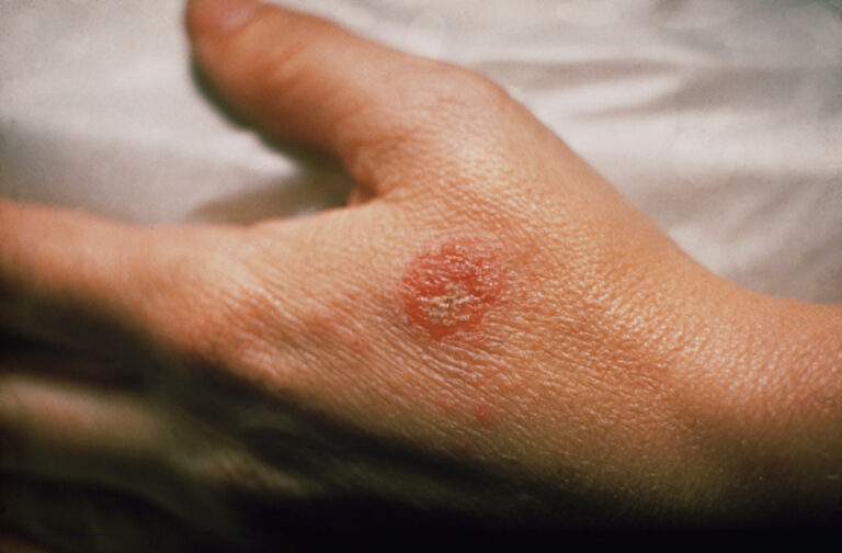 How to Use Apple Cider Vinegar for Ringworm Treatment?
