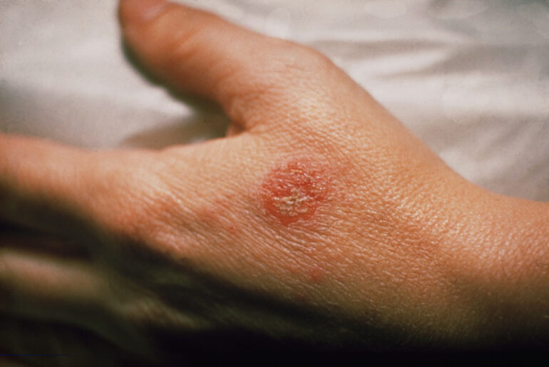 Apple Cider Vinegar for Eczema