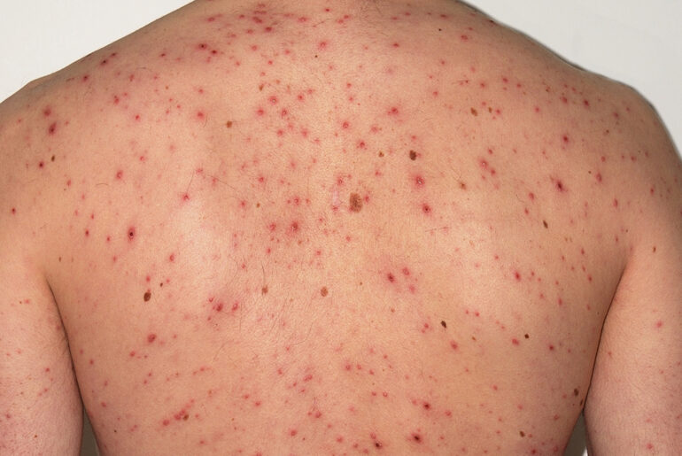 Chickenpox Scars Home Remedies
