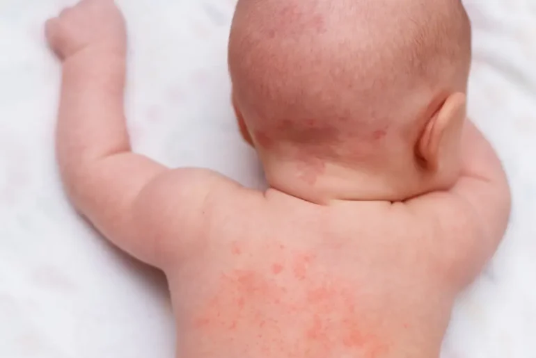 Essential Oils for Heat Rash