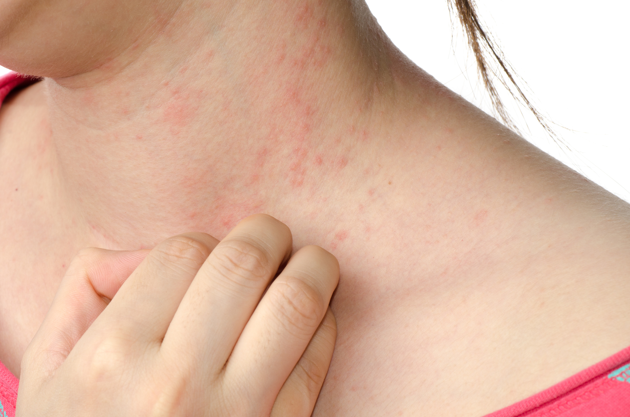How To Get Rid Of Eczema 11 Natural Ways You May Try Naturally Daily
