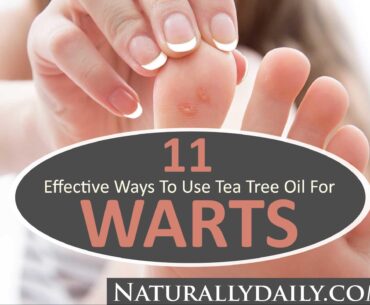 11-Effective-Ways-to-Use-Tea-Tree-Oil-for-Warts
