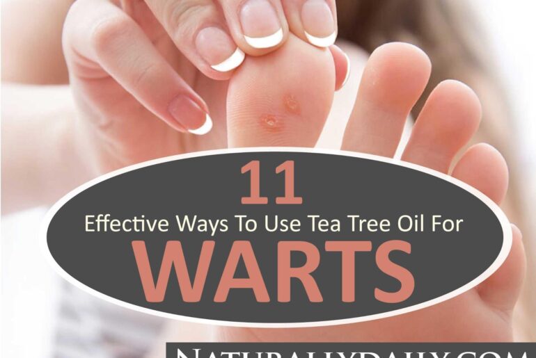 11-Effective-Ways-to-Use-Tea-Tree-Oil-for-Warts