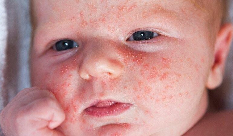 8-Safe-Home-Remedies-for-Baby-Acne