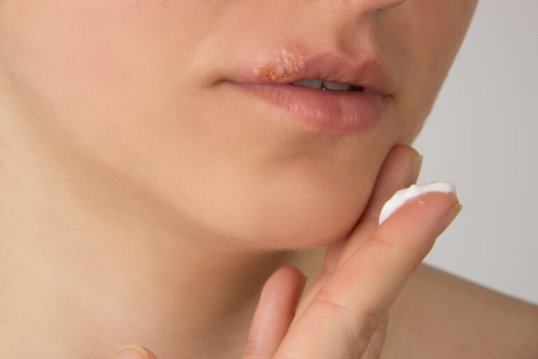 Get Rid of Fever Blisters