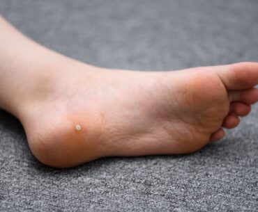 Home Remedies for Wart