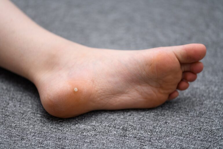 Home Remedies for Wart