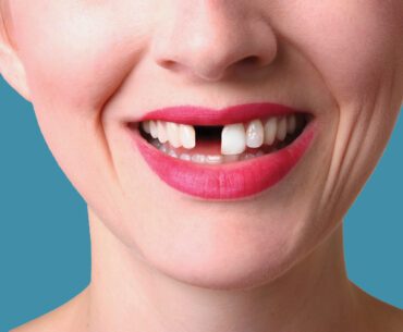 Missing-Teeth